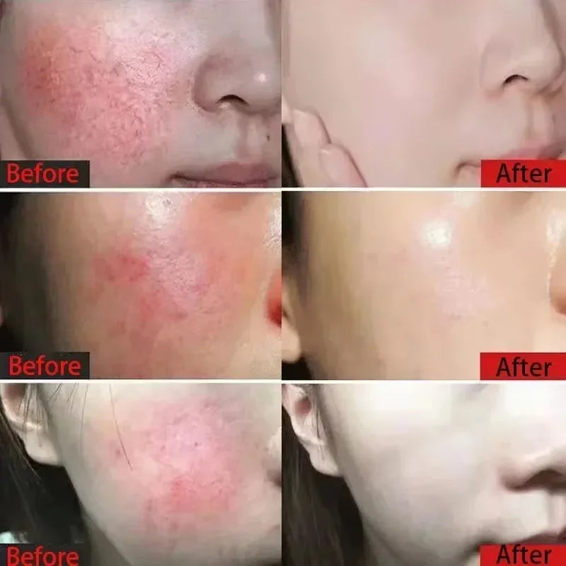 Facial Redness Repair Cream