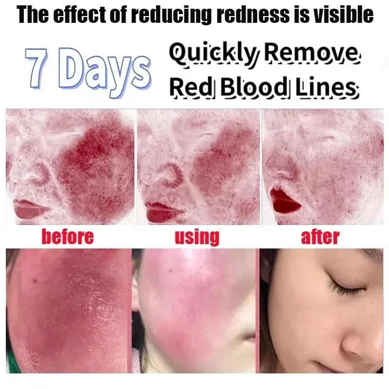 Facial Redness Repair Cream