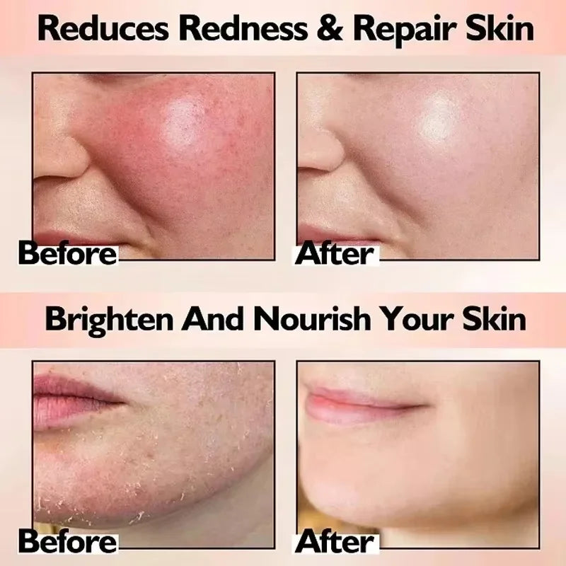 Facial Redness Repair Cream